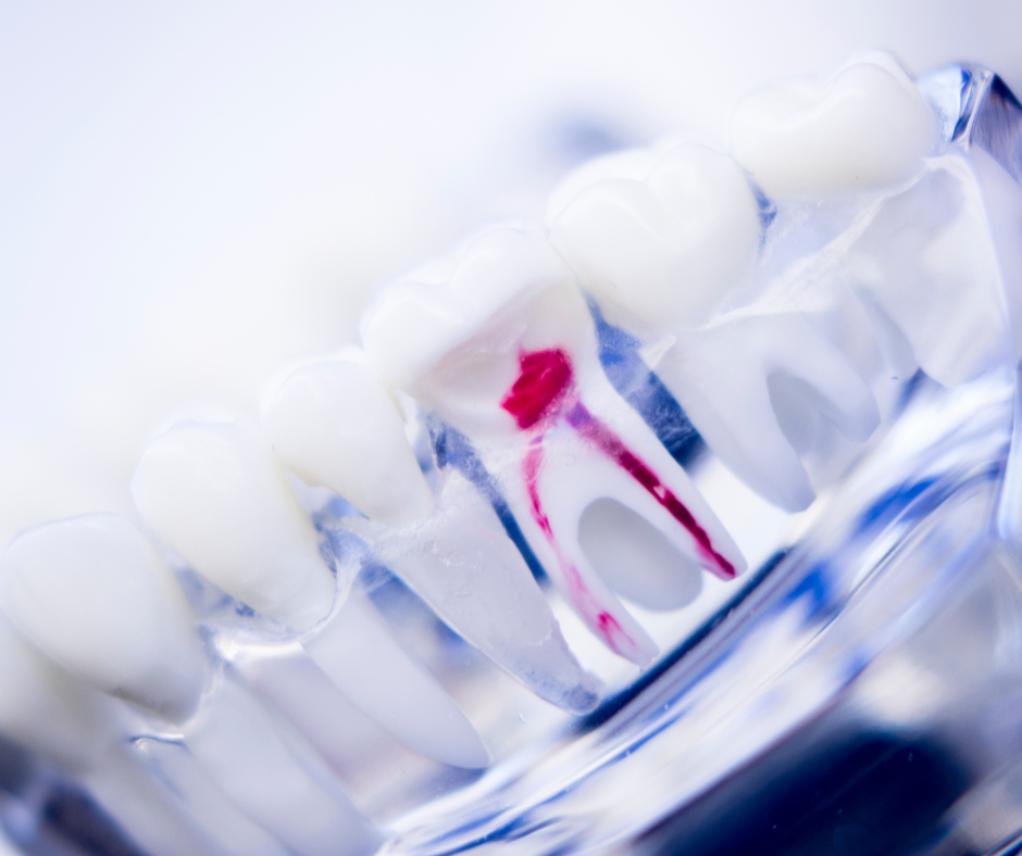 Dental Implants