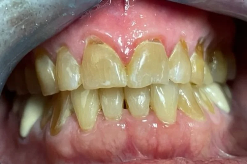 Actual Patient before Veneers