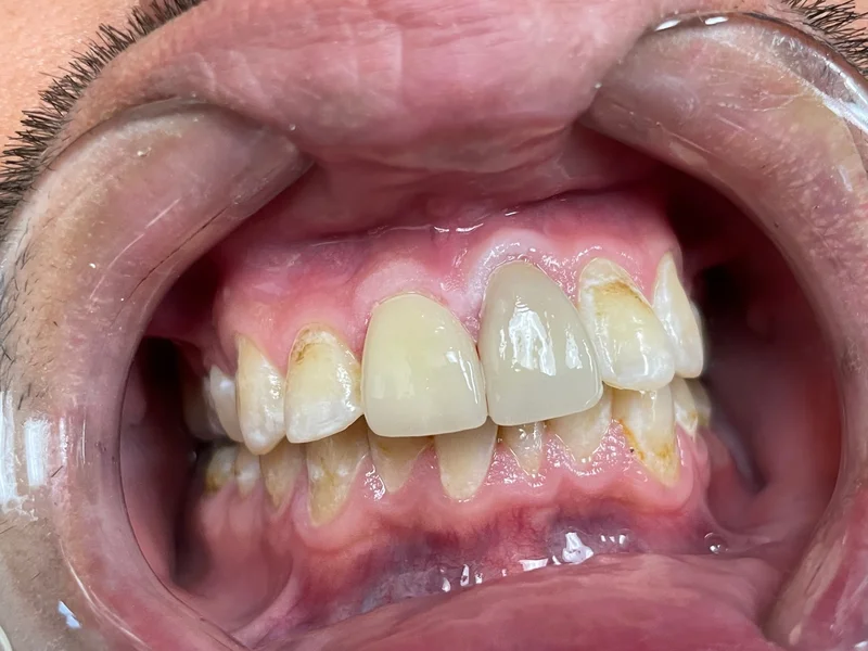 Actual Patient after Cosmetic Dentistry