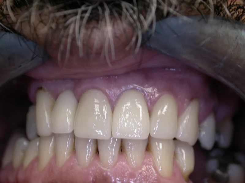 Actual Patient after Cosmetic Dentistry