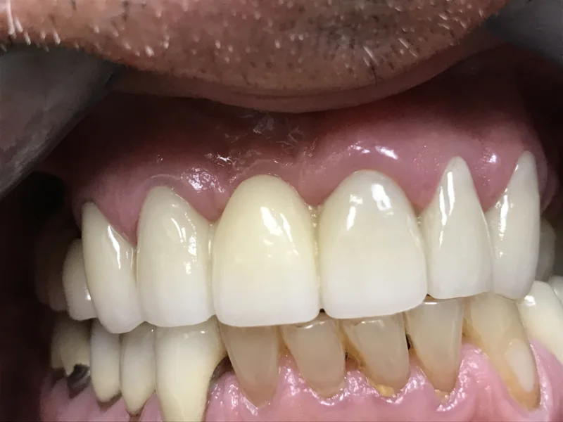 Actual Patient after Veneers