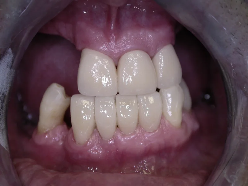 Actual Patient after Crowns