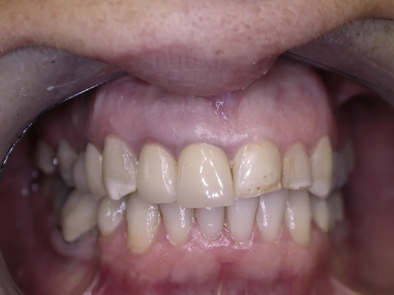 Actual Patient before Crowns