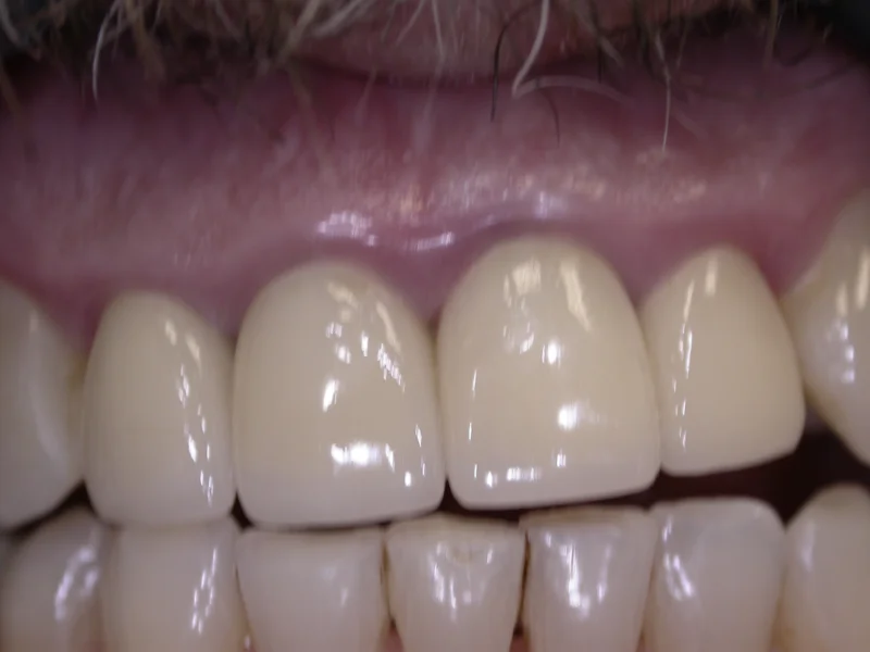 Actual Patient after Crowns